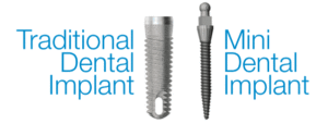 Traditional Dental Implant vs. Mini Dental Implant