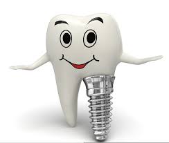 dental implant