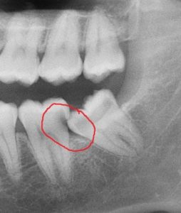 Partial X-Ray of Impacted Wisdom Tooth