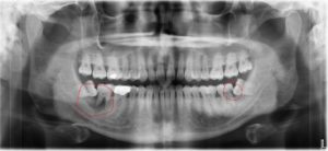 Full X-Ray of Two Impacted Wisdom Teeth - Bottom Row