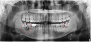 Full X-Ray of Two Impacted Wisdom Teeth - Bottom Row