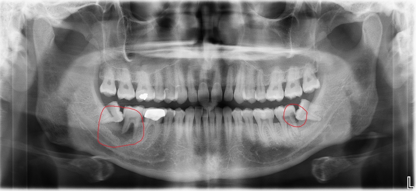 Sideways out tooth growing Hyperdontia: Symptoms,