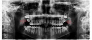Full X-Ray of Two Impacted Wisdom Teeth - Top Row