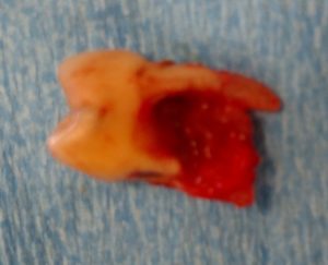 Extracted Impacted Wisdom Tooth - 1