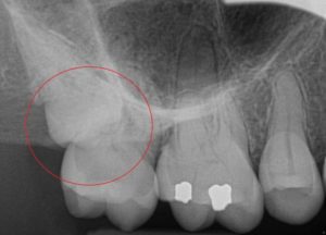 X-Ray of Resorbed Wisdom Tooth
