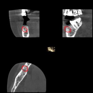 X-Ray of Tooth Fragment from Previous Extraction - 1