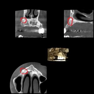 X-Ray of Tooth Fragment from Previous Extraction - 2