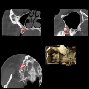 X-Ray of Tooth Fragment from Previous Extraction - 3