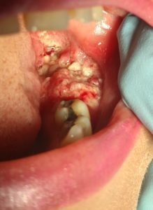 Tissue Growth from Previous Tooth Extraction