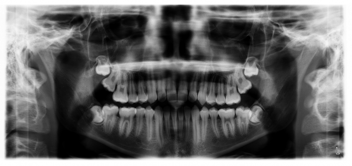 Wisdom Teeth xray