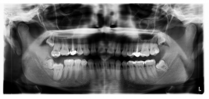 Wisdom Teeth xray