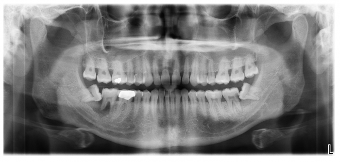 Wisdom Teeth xray