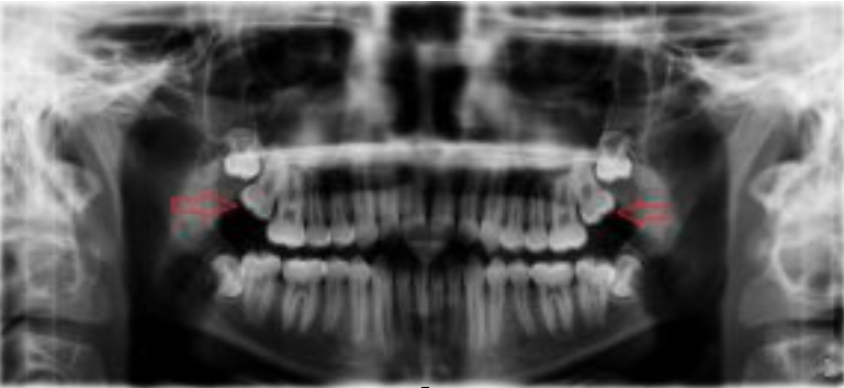 Impacted Teeth X-Ray - Upper Row Wisdom Teeth