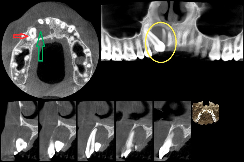 Impacted Tooth X-Ray Chart - A