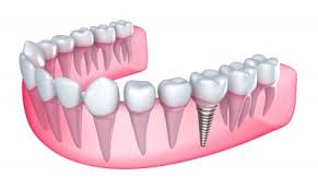 Dental Implants illustration - Dental Implant Temecula CA