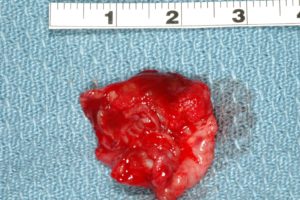 Extracted Cystic Lesion from Oral Pathology Treatment