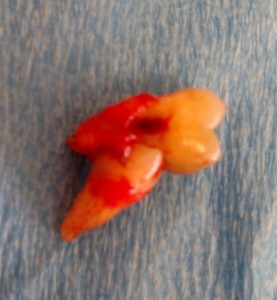 Extracted Impacted Wisdom Tooth - 2