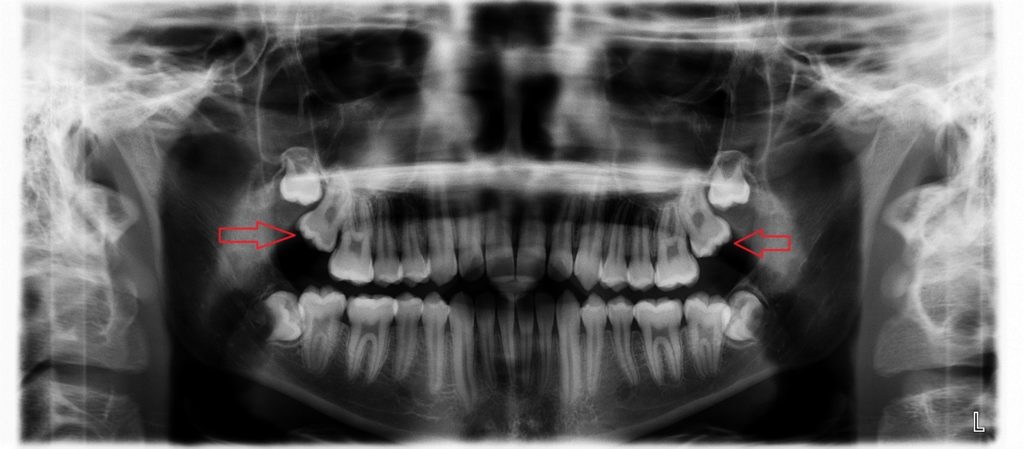An x-ray showing impacted teeth growing irregularly on both ends of the