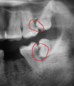 X-Ray of Top and Bottom Impacted Wisdom Teeth