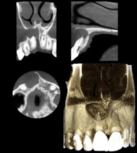 Radiograph of Large Periapical Lesion with Tooth