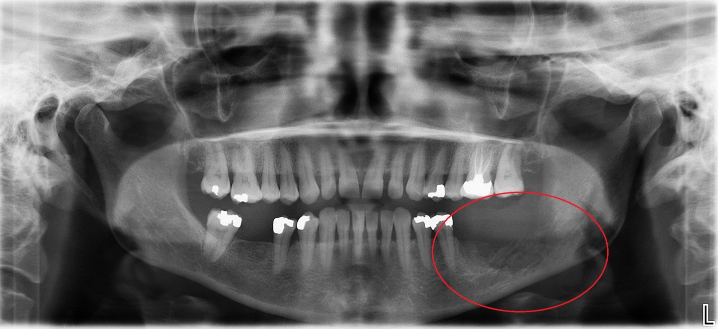XRay of Dark Resorption in Jaw Bone Duplicate