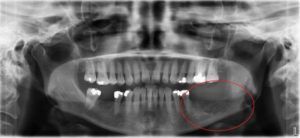 X-ray Showing Removal of Wisdom Teeth