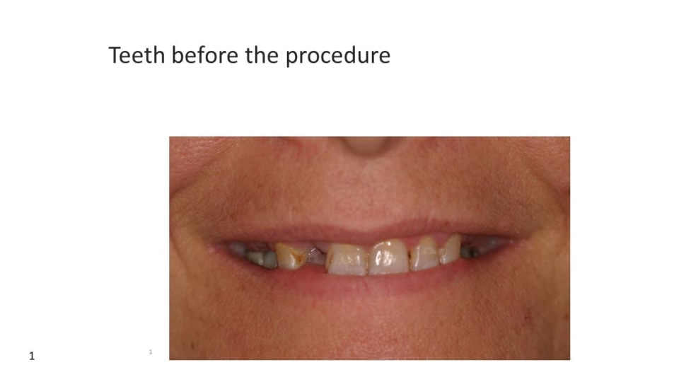 missing teeth - all on 4 dental temecula