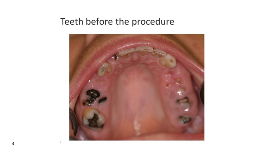 decayed teeth - all on 4 dental implants temecula ca