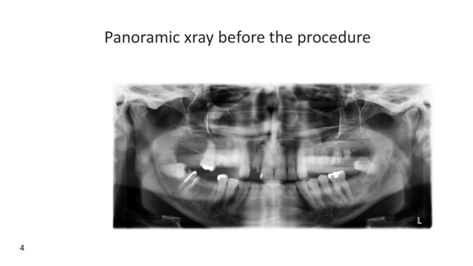 Pre-treatment X-ray - temecula all on 4 dental implants