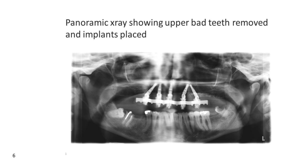 Implant placement - all-on-4 dental implants near me