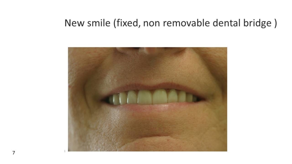 Fixed dental bridge - all-on-4 dental implant specialist in temecula