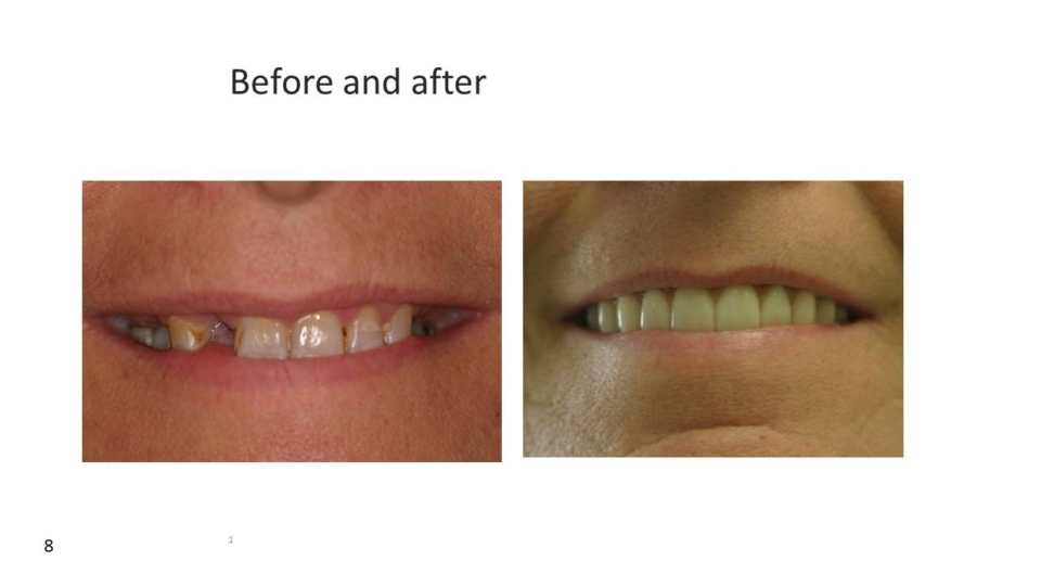 Before & after - all-on-4 dental implants temecula