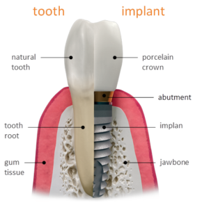 Side by Side Diagram of Tooth and Dental Implant