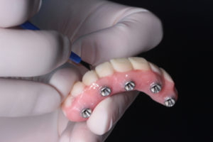 All-on-4 dental implants & quality of life