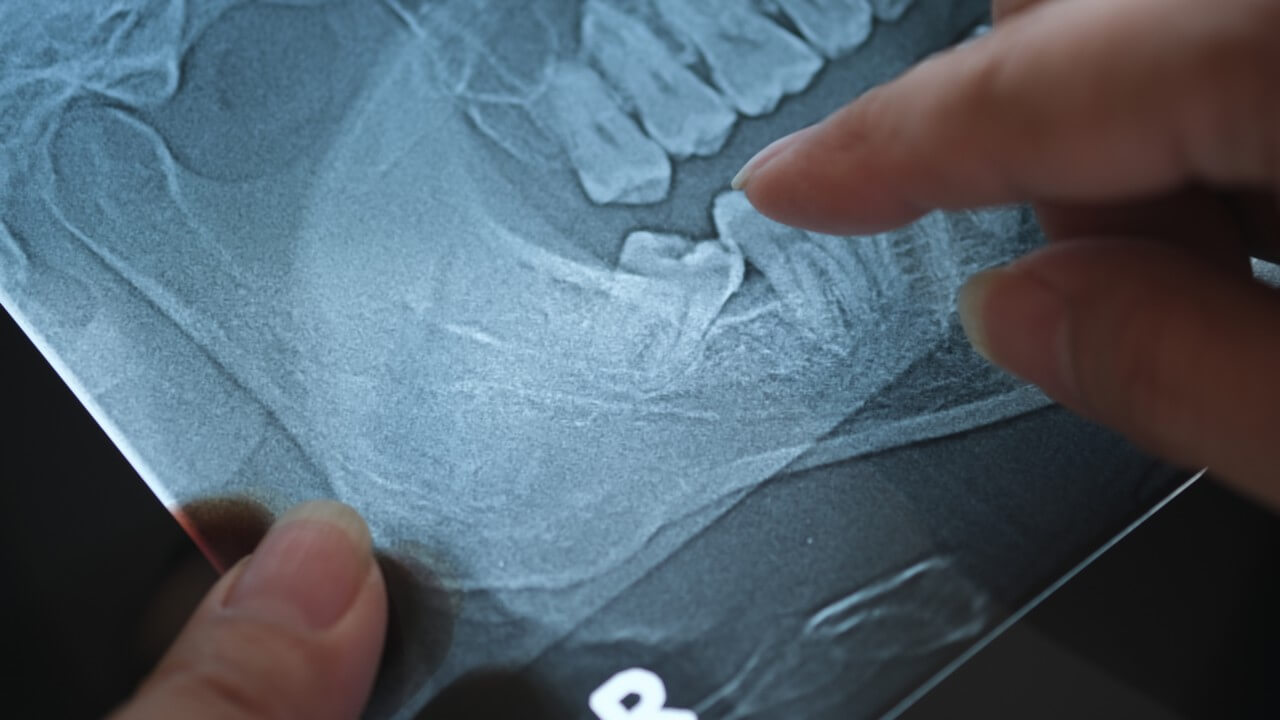 healing timeline for gums and bone