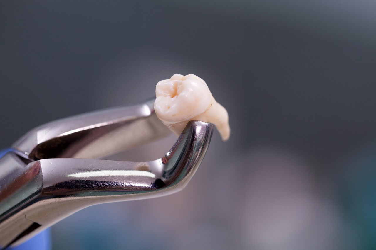 jaw stiffness after extraction