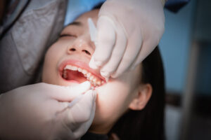 Is an impacted wisdom tooth an emergency