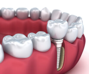 Looking for a dentist & implant specialist in Murrieta