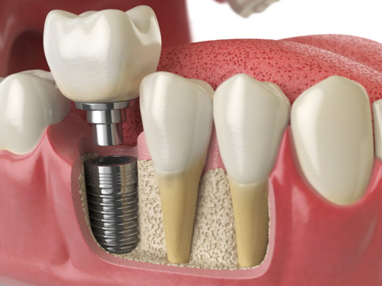 What Is Terminal Dentition Stage? Dental Implants Murrieta