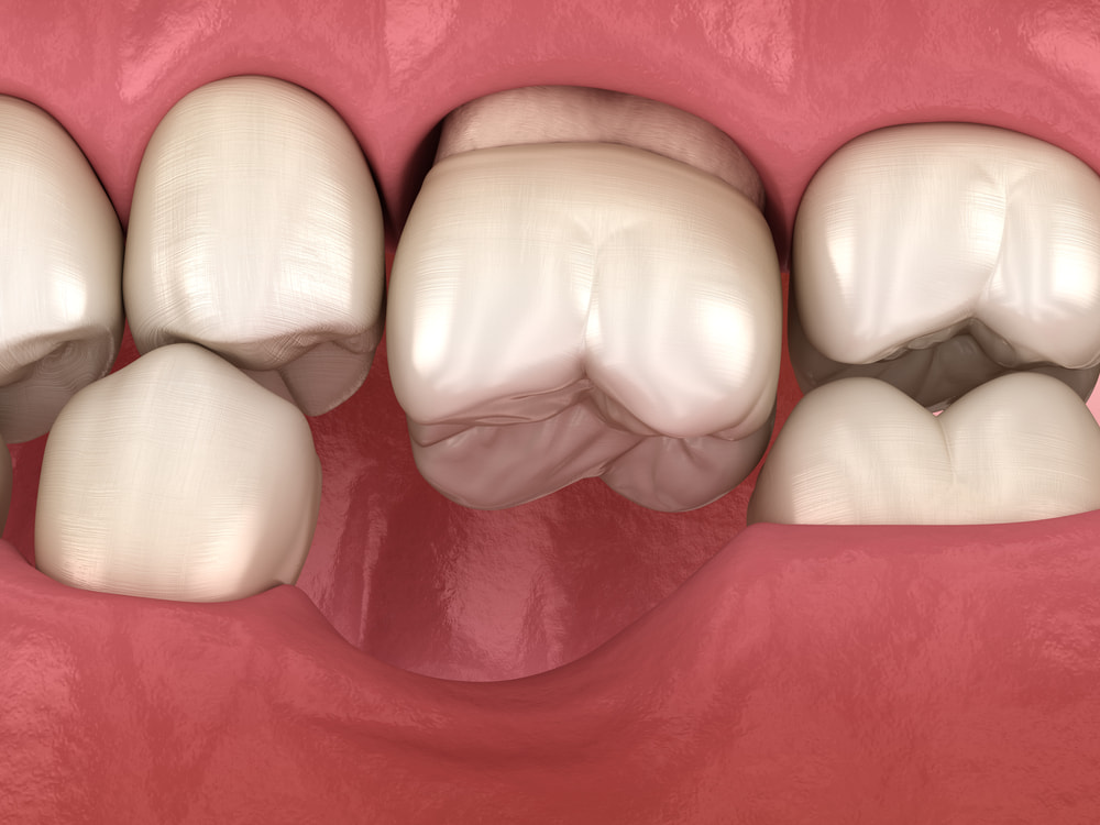 What Is Terminal Dentition Stage? Dental Implants Murrieta