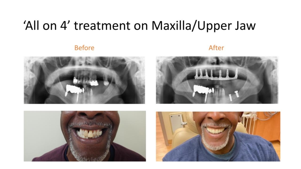 all-on-4-maxilla-upper-jaw-01