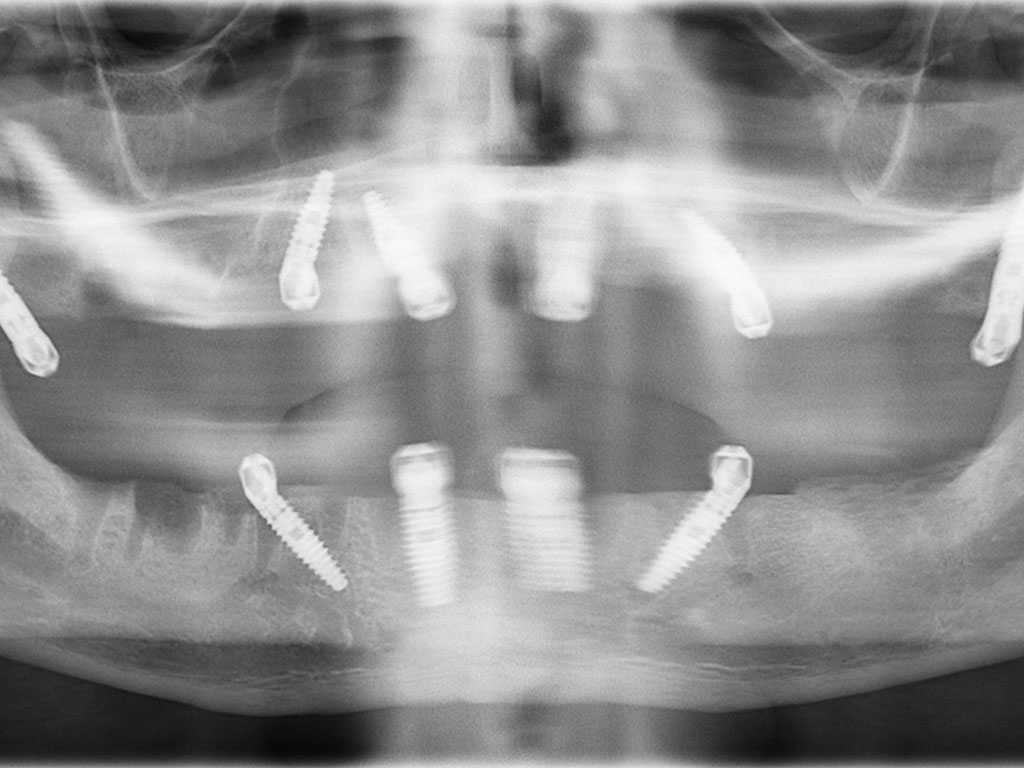 Allon4 Dental Implants Temecula Dental Implants & Oral Surgery