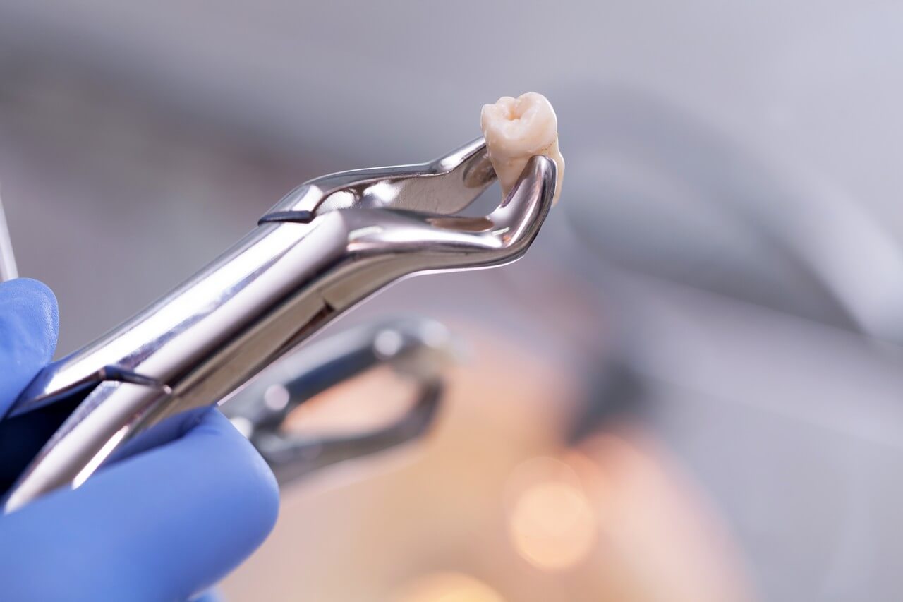 what to avoid after wisdom teeth removal