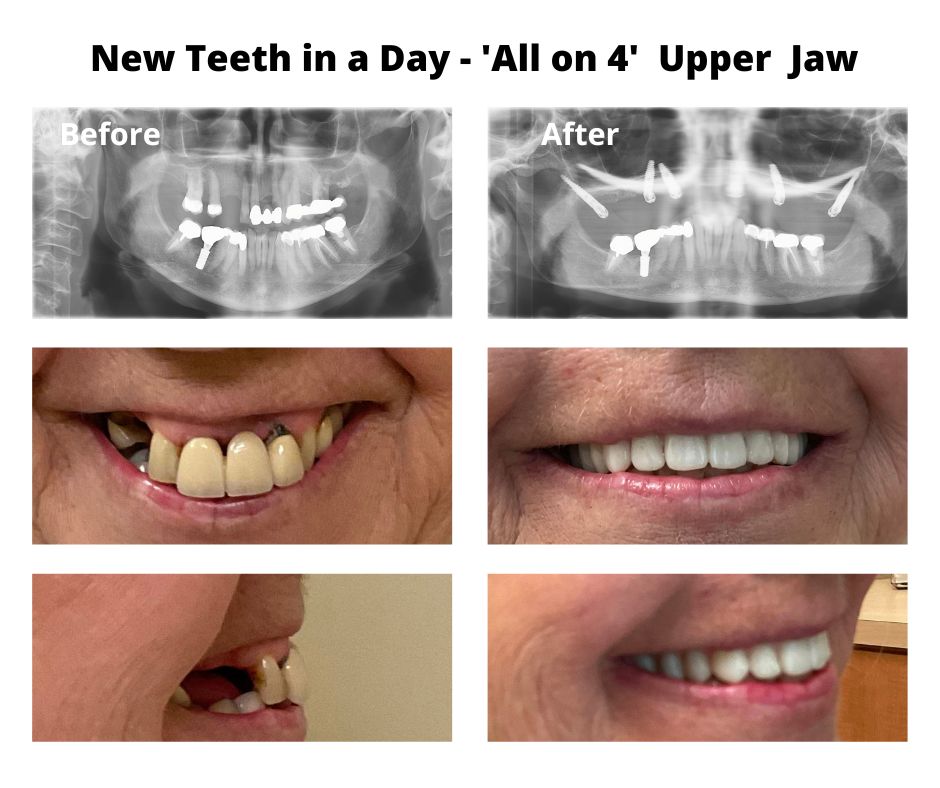 Zygomatic and Pterygoid Implants 🥇 Temecula Facial Oral Surgery