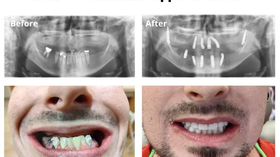 Allon4 Dental Implants Temecula Dental Implants & Oral Surgery