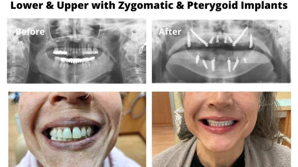 Allon4 Dental Implants Temecula Dental Implants & Oral Surgery