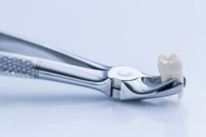 Wisdom tooth extraction: when is it an emergency?
