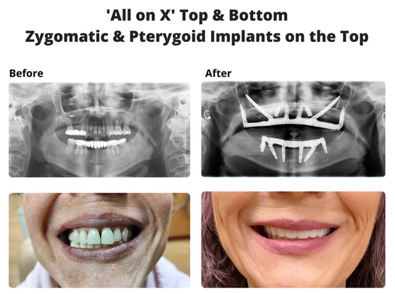 Zygomatic & Pterygoid Implants Temecula dental Implants & Oral Surgery