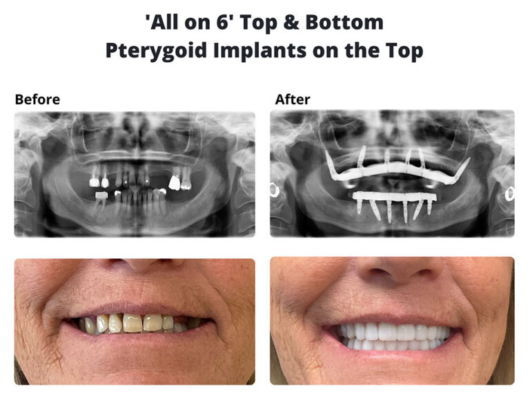 Zygomatic & Pterygoid Implants Temecula dental Implants & Oral Surgery