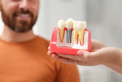 How long is a dental implant sensitive